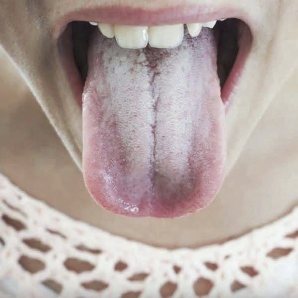 White Tongue Sign of Illness