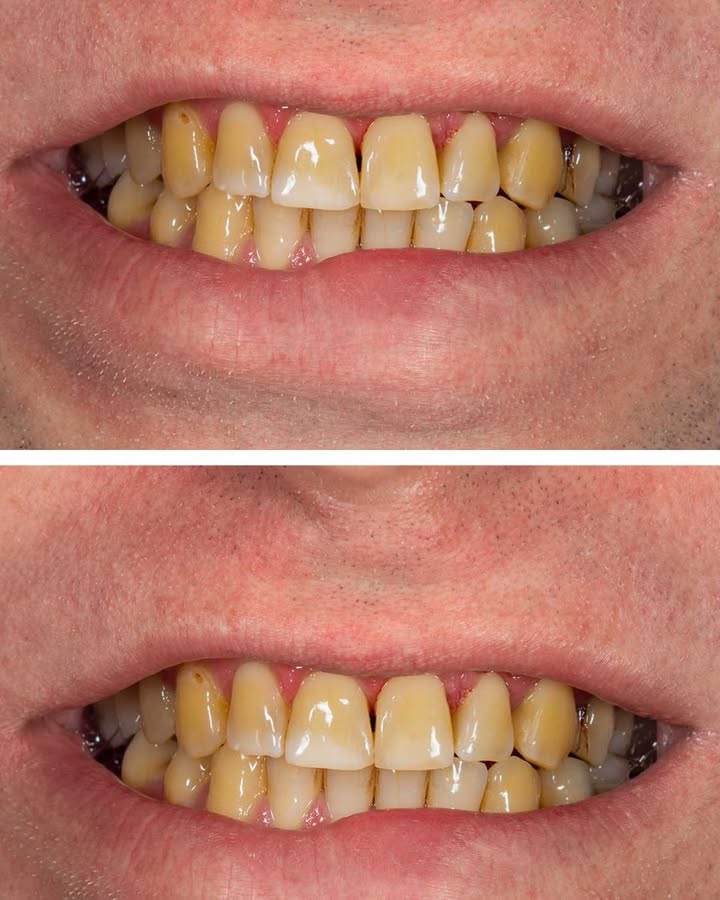 Dentists Wont Tell You This 8 Hacks To Do Teeth Whitening At Home