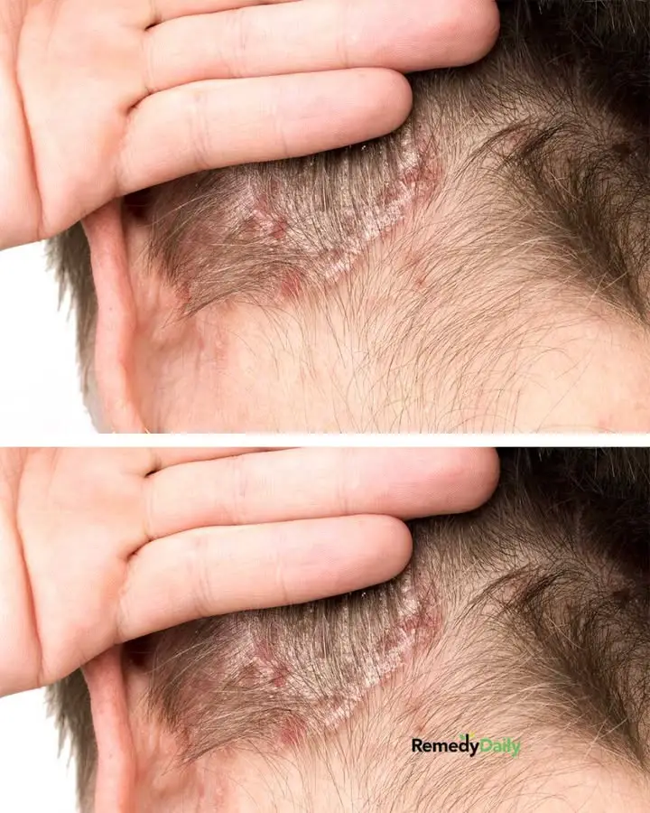 Found This On My Sons Scalp